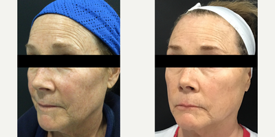 Case: 11488 - before and after photo of 55-64 year old woman treated with VI Peel and Morpheus8 by Rosy Sandhu, MD
