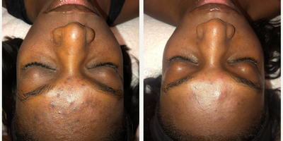 Case: 11489 - before and after photo of Woman treated with VI Peel by Ben J. Childers, MD, FACS