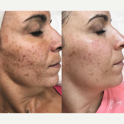 Case: 11490 - before and after photo of 25-34 year old woman treated with VI Peel by Fernando Colon, MD
