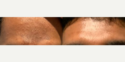 Case: 11491 - before and after photo of Woman treated with VI Peel by Holly Gunn, MD