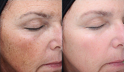 Case: 11492 - before and after photo of VI Peel by David Shafer, MD, FACS