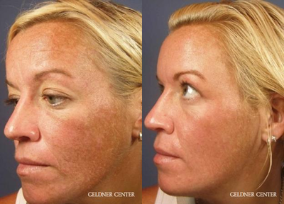 Case: 11493 - before and after photo of Woman treated with VI Peel by Peter D. Geldner, MD