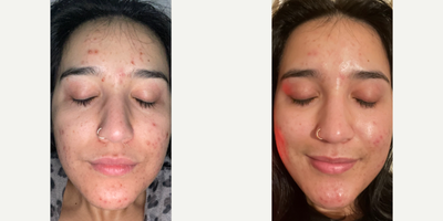 Case: 11494 - before and after photo of 25-34 year old woman treated with VI Peel Purify by Neetu Nebhwani, MD