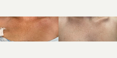 Case: 11495 - before and after photo of Woman treated with VI Peel by Joseph A. Russo, MD