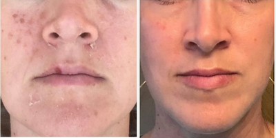 Case: 11496 - before and after photo of 35-44 year old woman treated with VI Peel and Aerolase Neo by W. Christopher Croley, MD