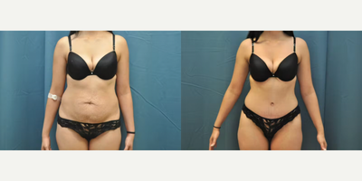 Case 115 - Woman treated with Tummy Tuck