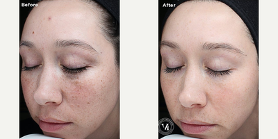 Case 11512 - Woman treated with VI Peel