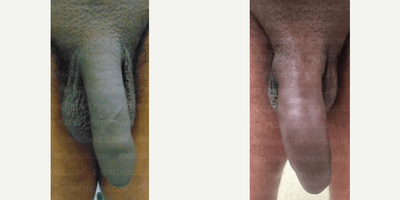 Case: 11513 - before and after photo of Man treated with Penis Fillers, Penis Enlargement by Farhan Malik, MD