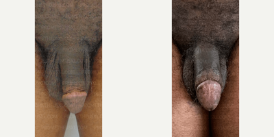 Case: 11514 - before and after photo of Man treated with Penis Fillers, Penis Enlargement by Farhan Malik, MD