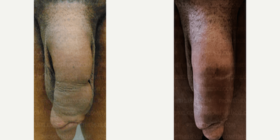 Case: 11515 - before and after photo of Man treated with Penis Fillers, Penis Enlargement by Farhan Malik, MD