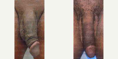 Case: 11516 - before and after photo of Man treated with Penis Fillers, Penis Enlargement by Farhan Malik, MD