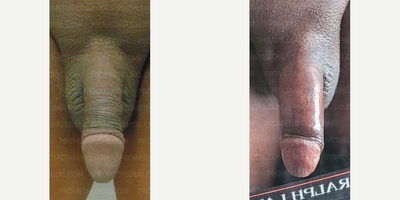 Case: 11517 - before and after photo of Woman treated with Penis Enlargement by Farhan Malik, MD