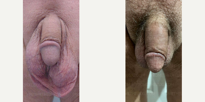 Case: 11518 - before and after photo of Woman treated with Penis Enlargement by Farhan Malik, MD