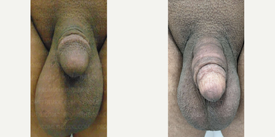 Case: 11519 - before and after photo of Woman treated with Penis Enlargement by Farhan Malik, MD