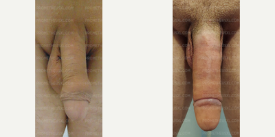 Case: 11520 - before and after photo of Woman treated with Penis Enlargement by Farhan Malik, MD