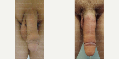 Case: 11521 - before and after photo of Woman treated with Penis Enlargement by Farhan Malik, MD