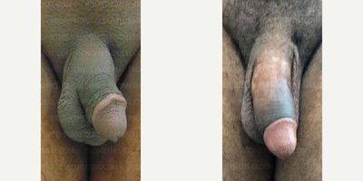 Case 11522 - Woman treated with Penis Enlargement