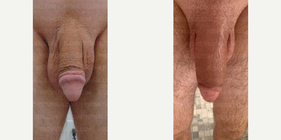 Case 11523 - Woman treated with Penis Enlargement