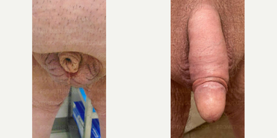 Case 11524 - Woman treated with Penis Enlargement