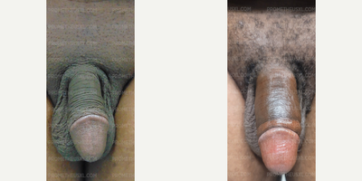 Case 11525 - Man treated with Penis Enlargement, Penis Fillers