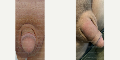 Case 11526 - Man treated with Penis Enlargement, Penis Fillers