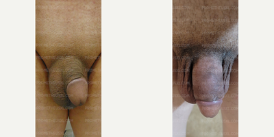 Case 11527 - Man treated with Penis Enlargement, Penis Fillers