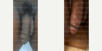 Case 11528 - Man treated with Penis Enlargement, Penis Fillers