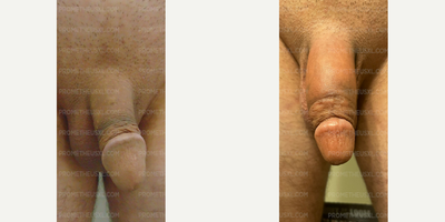 Case 11529 - Man treated with Penis Enlargement, Penis Fillers