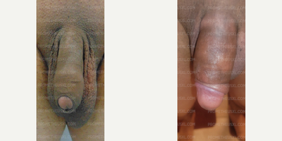 Case 11530 - Man treated with Penis Enlargement, Penis Fillers