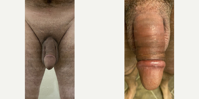 Case 11531 - Man treated with Penis Enlargement, Penis Fillers