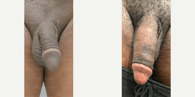 Case 11532 - Penis Enlargement