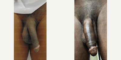 Case 11536 - Penis Enlargement