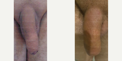 Case 11538 - Penis Enlargement