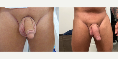 Case 11544 - 35-44 year old man treated with Penis Enlargement