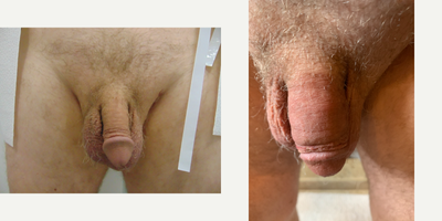 Case 11545 - 45-54 year old man treated with Penis Enlargement