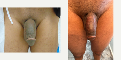 Case 11546 - 35-44 year old man treated with Penis Enlargement