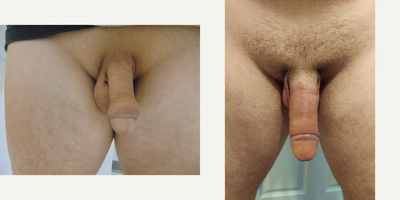 Case 11547 - 35-44 year old man treated with Penis Enlargement