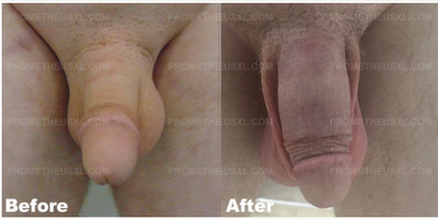 Case 11549 - Man treated with Penis Enlargement