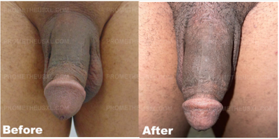 Case 11550 - Man treated with Penis Enlargement