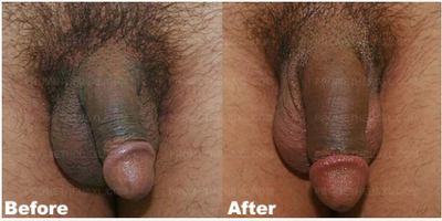 Case 11551 - Man treated with Penis Enlargement