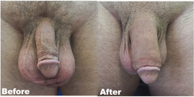 Case 11553 - Man treated with Penis Enlargement