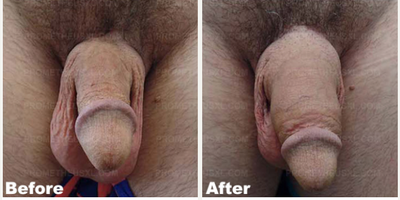 Case 11554 - Man treated with Penis Enlargement