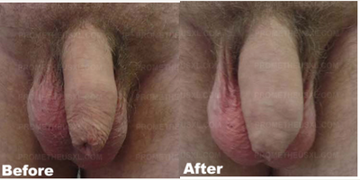 Case 11555 - Man treated with Penis Enlargement