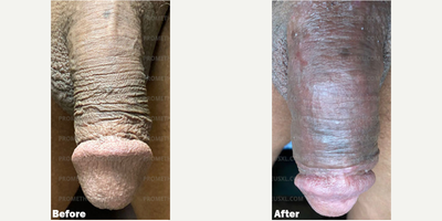 Case 11556 - Man treated with Penis Enlargement