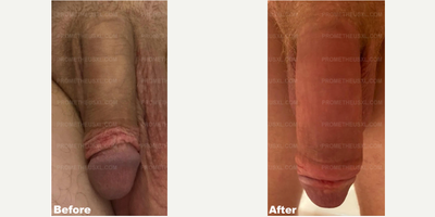 Case 11557 - Man treated with Penis Enlargement