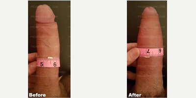 Case 11559 - Man treated with Penis Enlargement