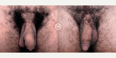 Case 11560 - Man treated with Penis Enlargement