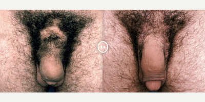 Case 11561 - Man treated with Penis Enlargement