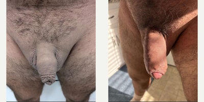 Case 11563 - Man treated with Penis Fillers, Penis Enlargement