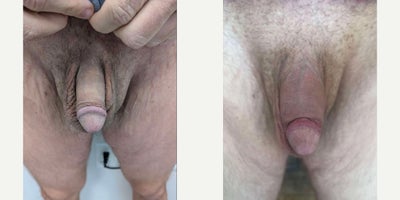 Case 11565 - Man treated with Penis Fillers, Penis Enlargement